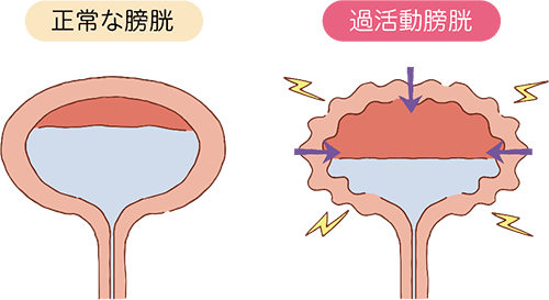 過活動膀胱と膀胱知覚