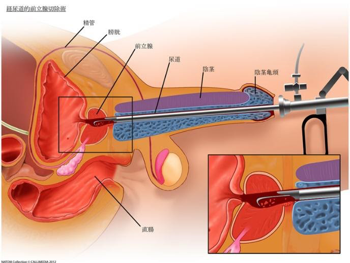 ・経尿道的前立腺切除術