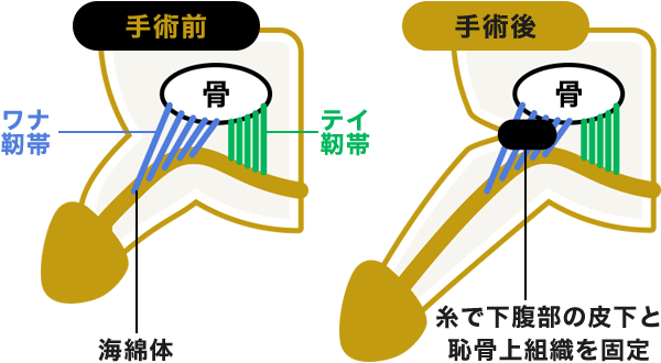 アトムクリニックの長茎術画像