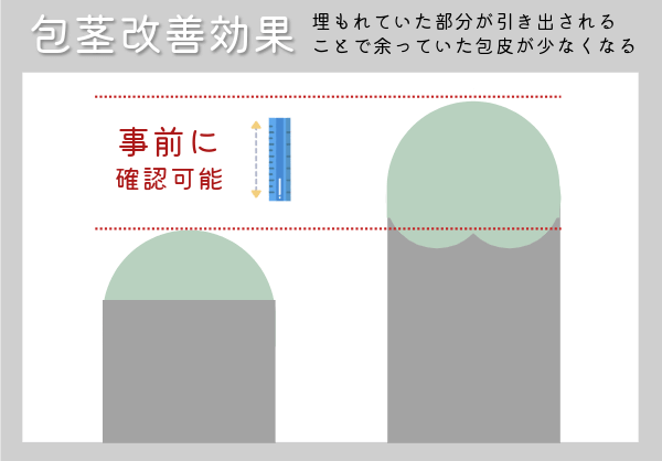 長茎手術は事前測定検診